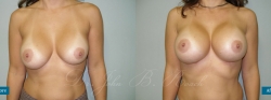 breastaug_patient21_01