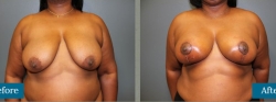 Breast Reduction and Lift