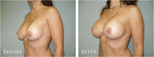 breast-augmentation-recovery-tampa-bay