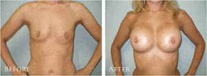 breast-enlargement-recovery-tampa